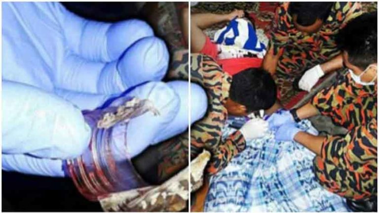 Wadaw! Gara-Gara Pipis di Botol, Alat Kelamin Pria Ini Tersangkut