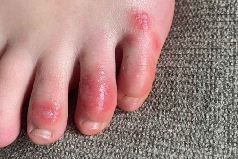 Ruam Pada Jari Kaki Bisa Jadi Gejala Covid-19, Tapi Jangan Langsung Panik